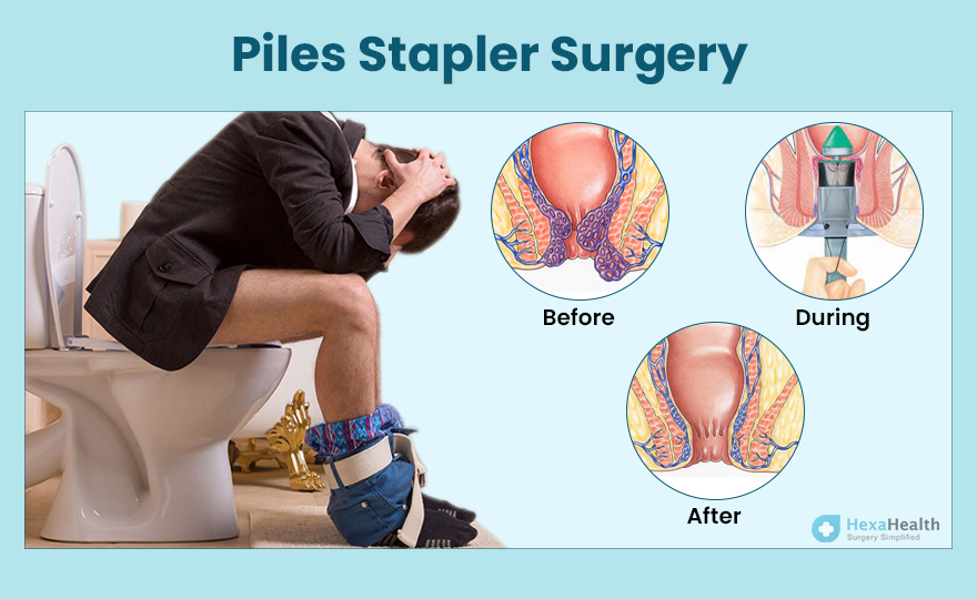 Stapler Surgery for Piles